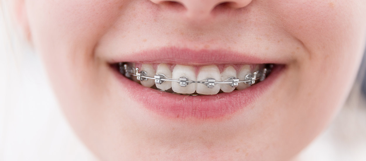 Zahnspangen für Kinder & Jugendliche in Fröndenberg, Hemmerde